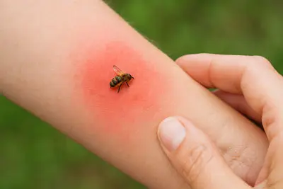 Betriebshaftpflicht für Imkerei haftet bei Bienenstich und Personenschaden